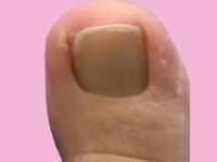 Teen met een nagel die in de nagelwal groeit